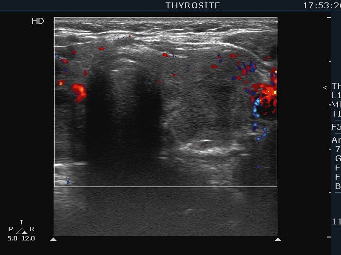 Right lobe, longitudinal scan