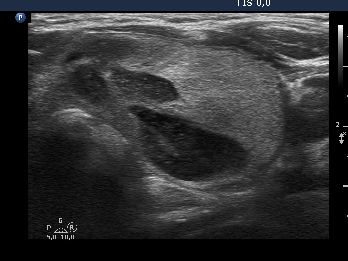 Right lobe, longitudinal scan