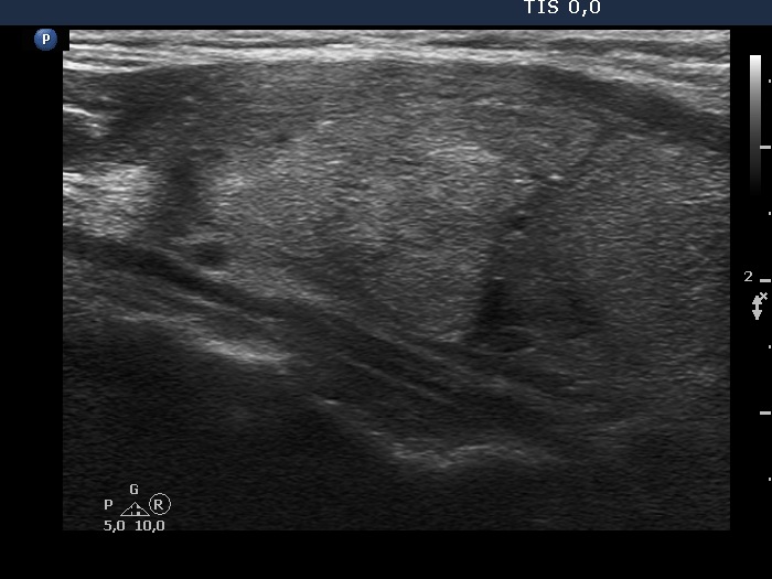 Right lobe, longitudinal scan