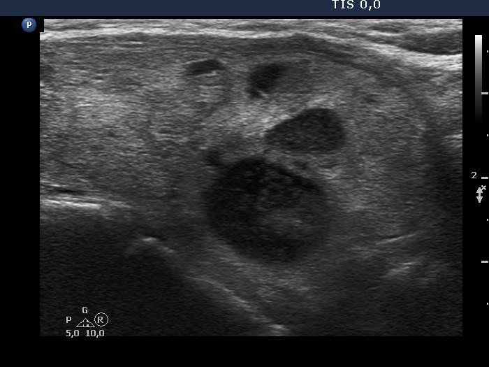 Right lobe, longitudinal scan