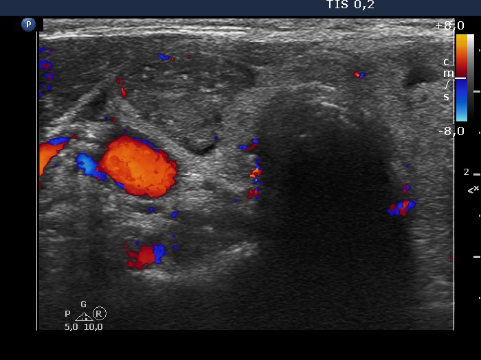 Right lobe, longitudinal scan