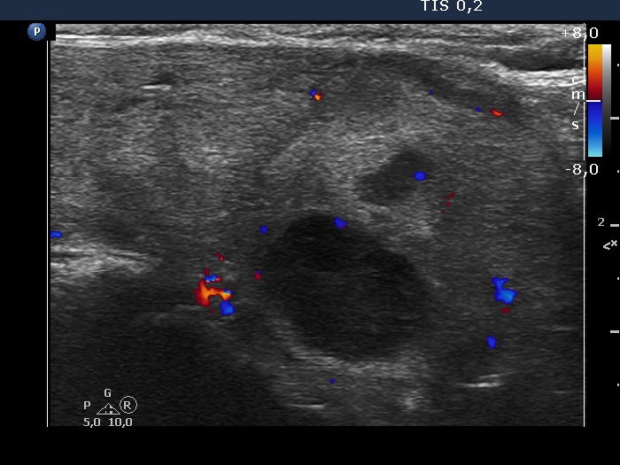 Right lobe, longitudinal scan