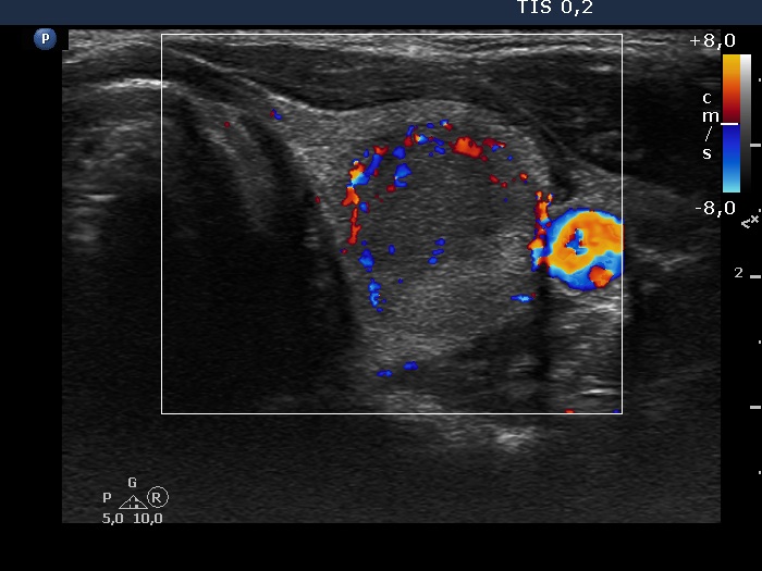 Right lobe, longitudinal scan