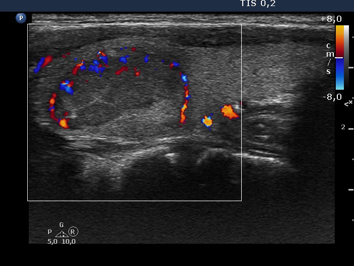 Right lobe, longitudinal scan