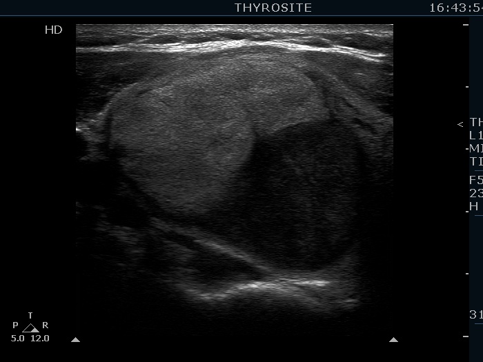 Right lobe, longitudinal scan