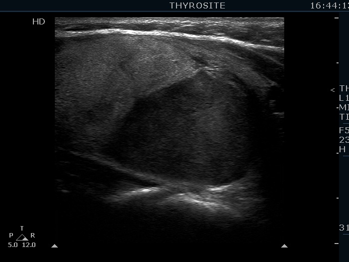 Right lobe, longitudinal scan