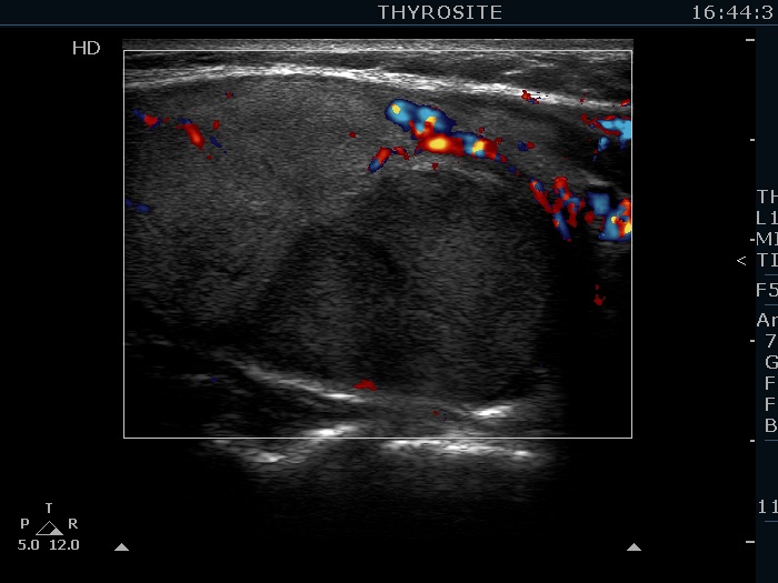 Right lobe, longitudinal scan
