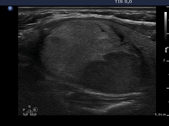 Right lobe, longitudinal scan