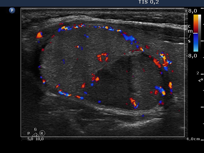 Right lobe, longitudinal scan