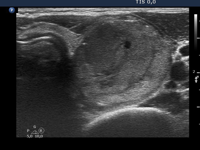 Right lobe, longitudinal scan