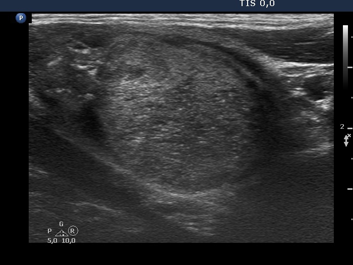 Right lobe, longitudinal scan