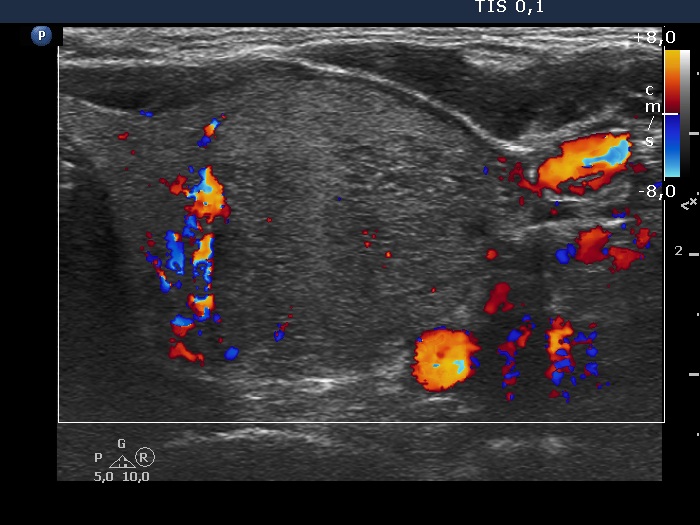 Right lobe, longitudinal scan