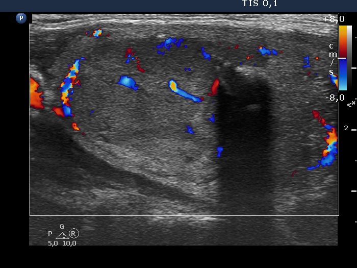 Right lobe, longitudinal scan