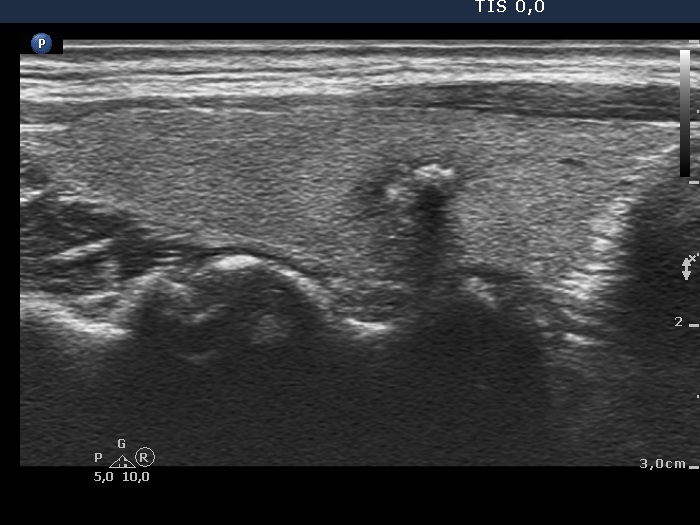 Right lobe, longitudinal scan
