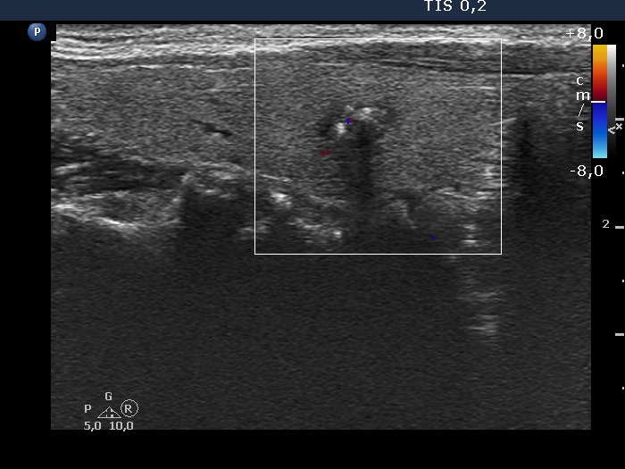 Right lobe, longitudinal scan