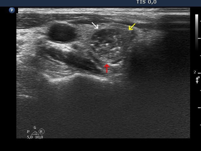Right lobe, longitudinal scan