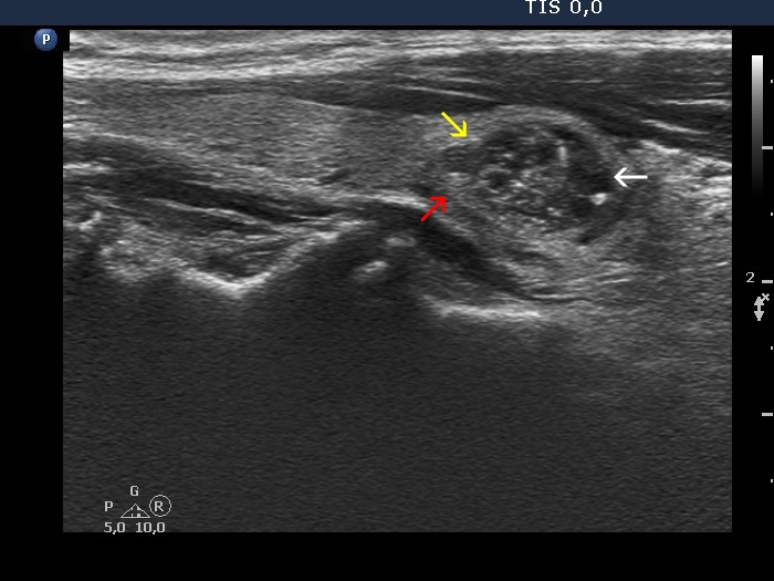 Right lobe, longitudinal scan