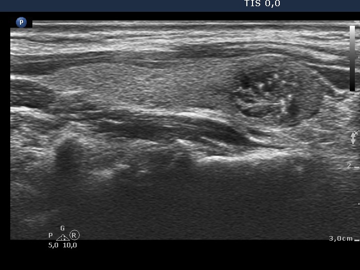 Right lobe, longitudinal scan