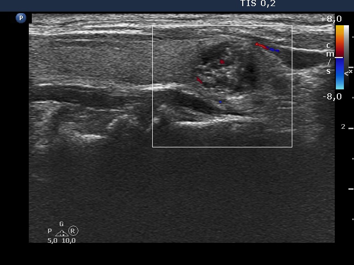 Right lobe, longitudinal scan