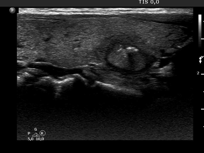Right lobe, longitudinal scan
