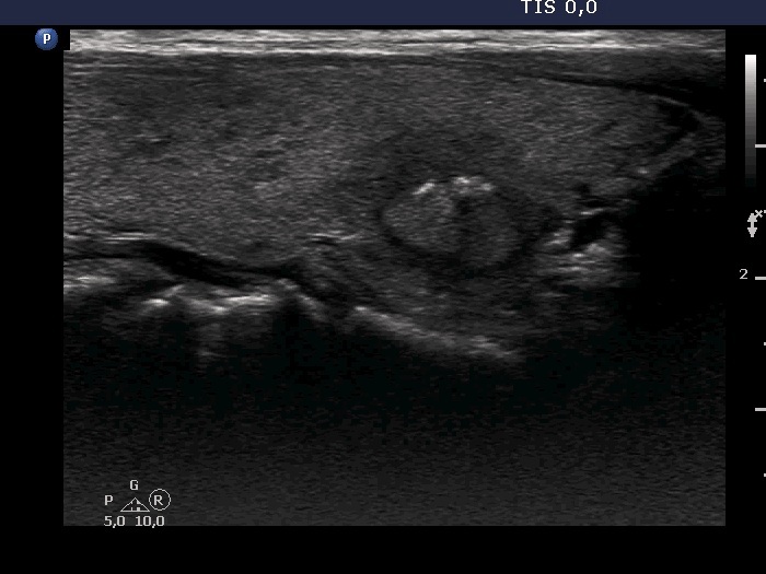 Right lobe, longitudinal scan