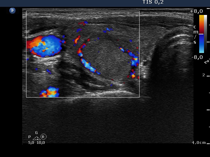 Right lobe, longitudinal scan