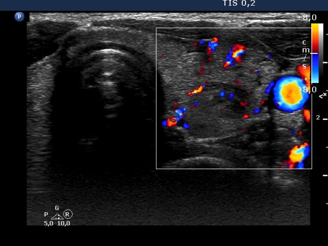 Right lobe, longitudinal scan