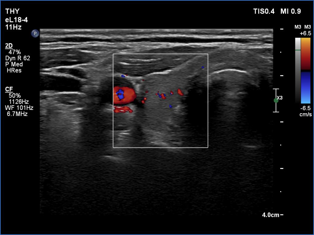 Right lobe, longitudinal scan