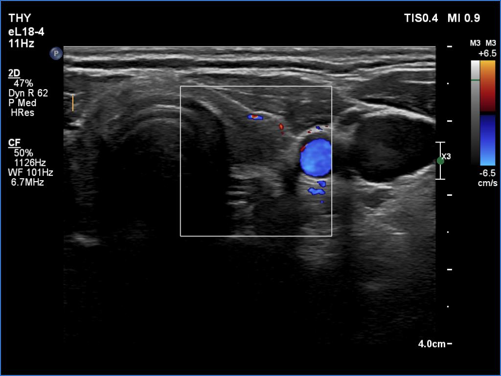 Right lobe, longitudinal scan