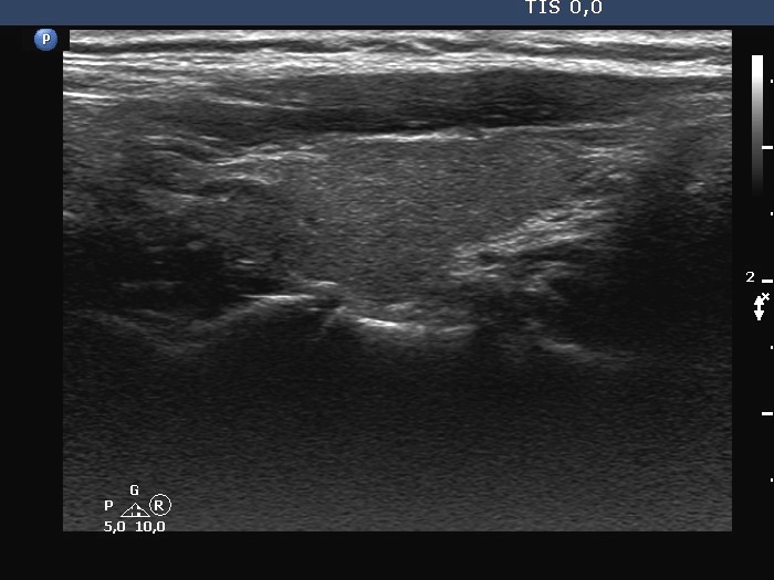 Right lobe, longitudinal scan