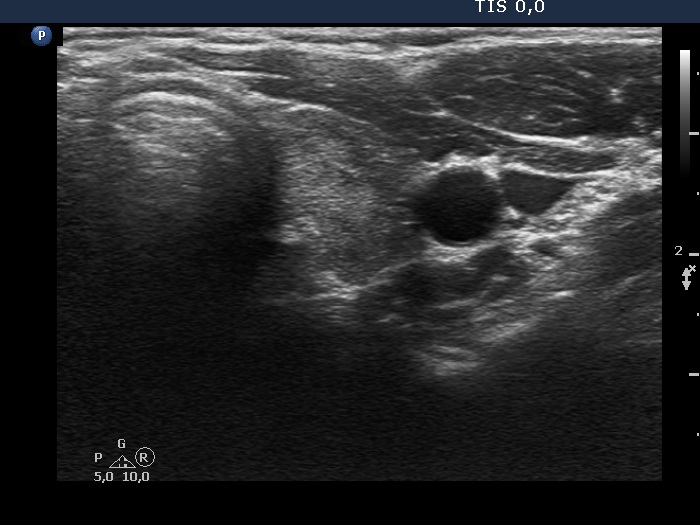 Right lobe, longitudinal scan