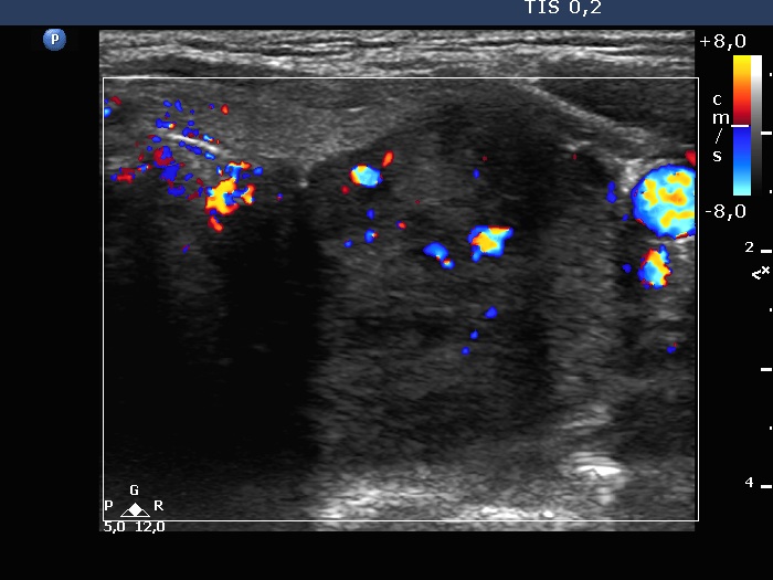 Right lobe, longitudinal scan