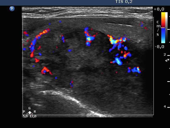 Right lobe, longitudinal scan