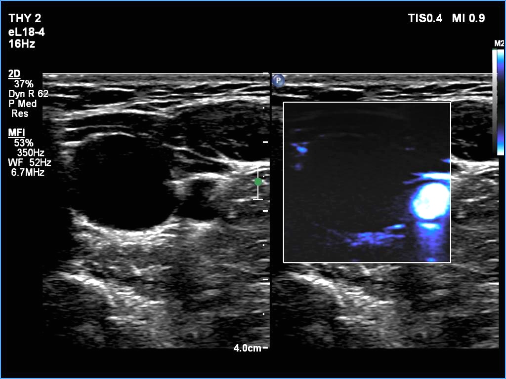 Right lobe, longitudinal scan