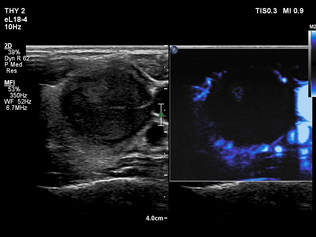 Right lobe, longitudinal scan