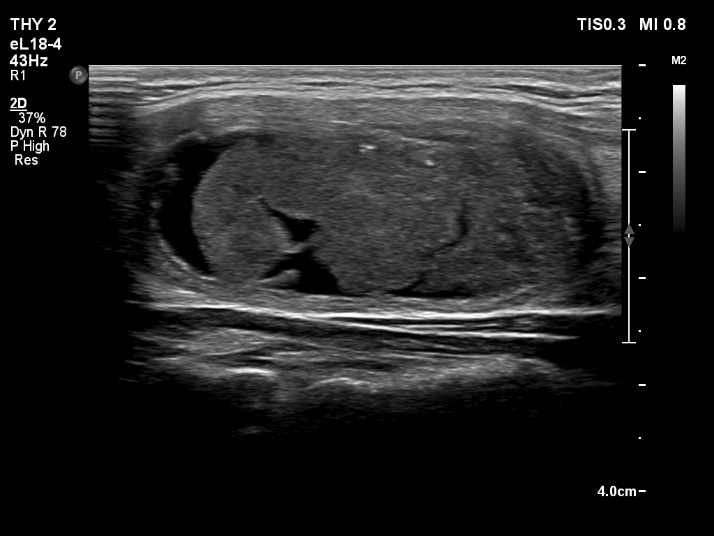 Right lobe, longitudinal scan