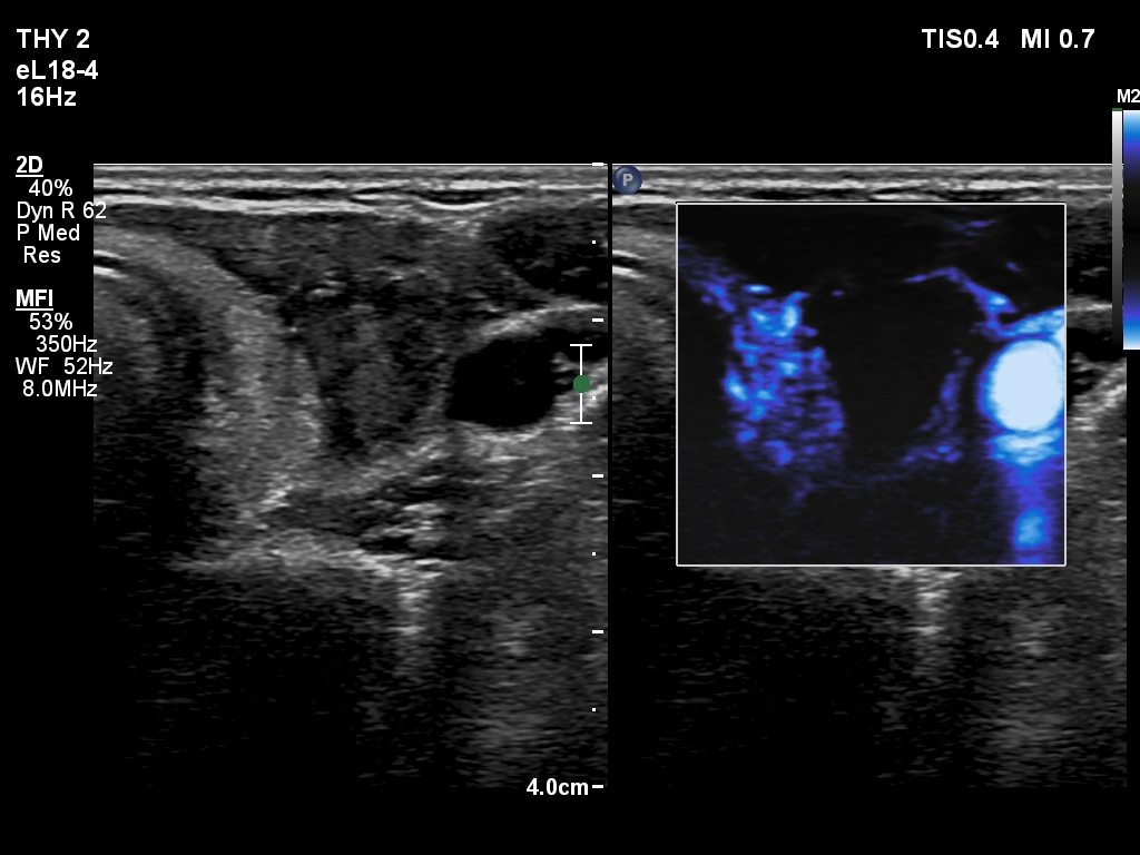 Right lobe, longitudinal scan