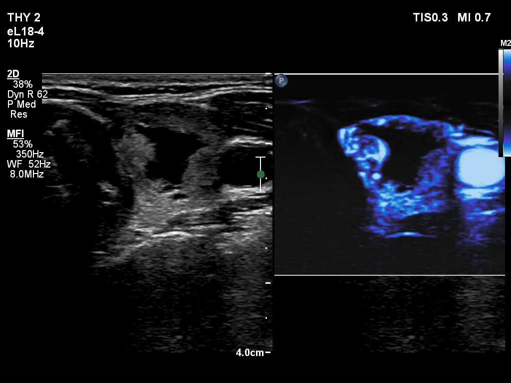 Right lobe, longitudinal scan
