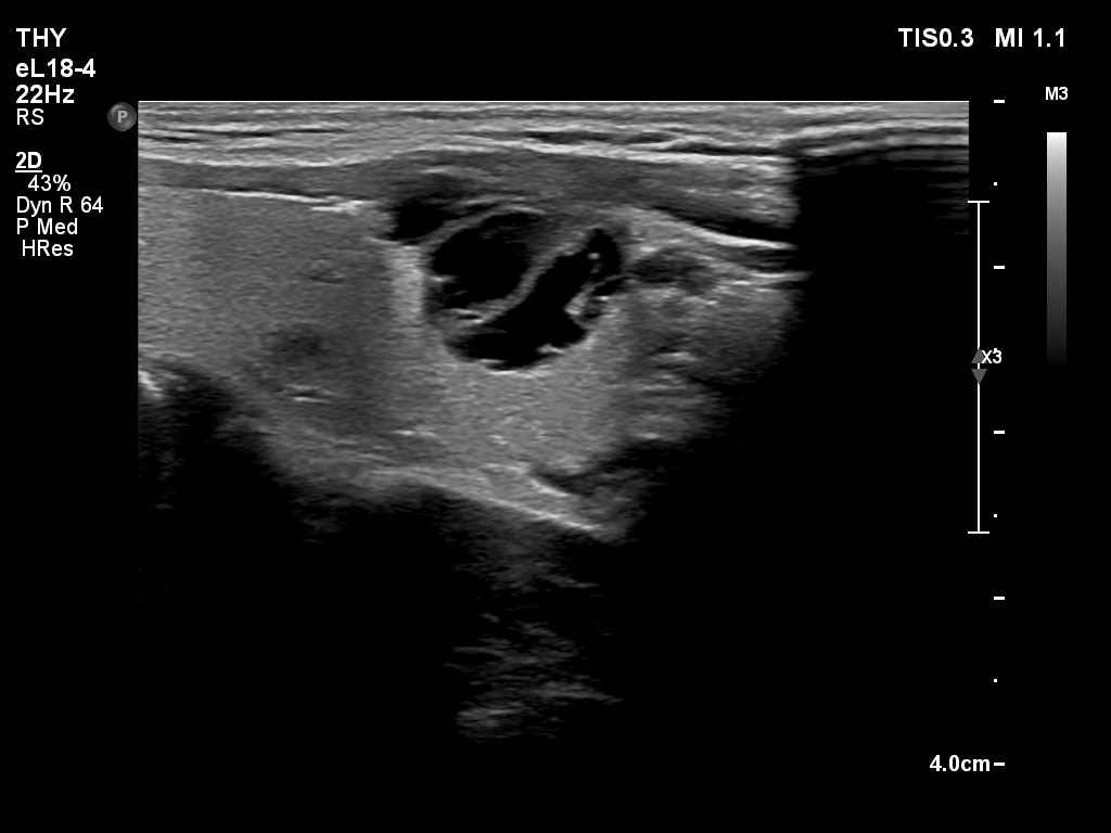 Right lobe, longitudinal scan