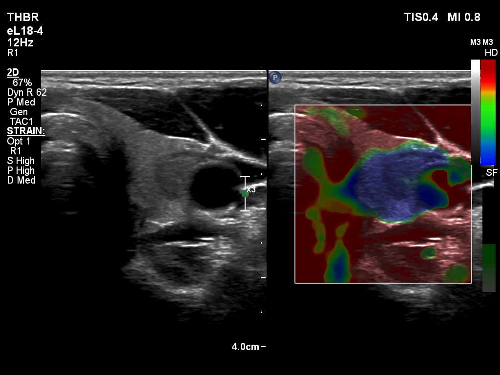 Right lobe, longitudinal scan
