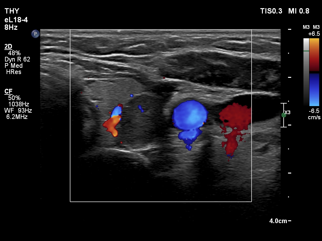Right lobe, longitudinal scan