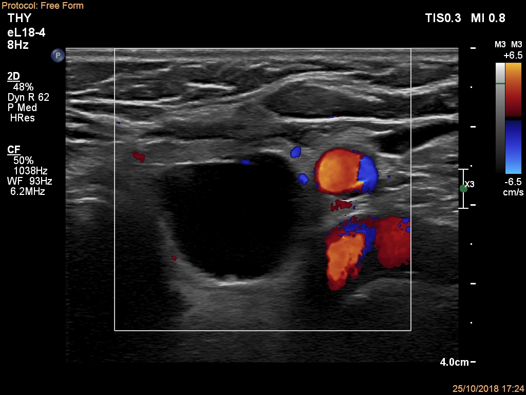 Right lobe, longitudinal scan