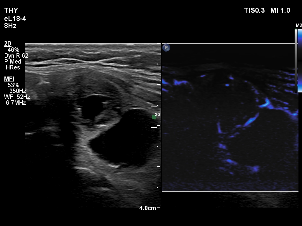 Right lobe, longitudinal scan