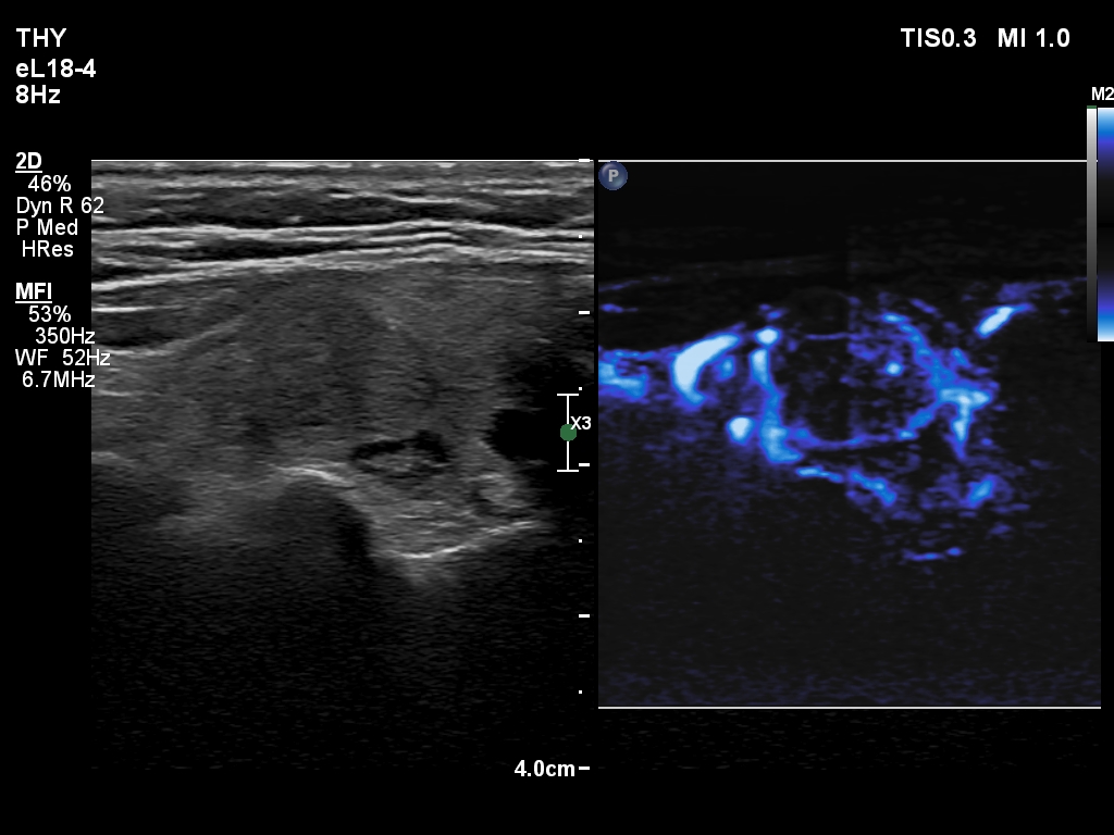 Right lobe, longitudinal scan