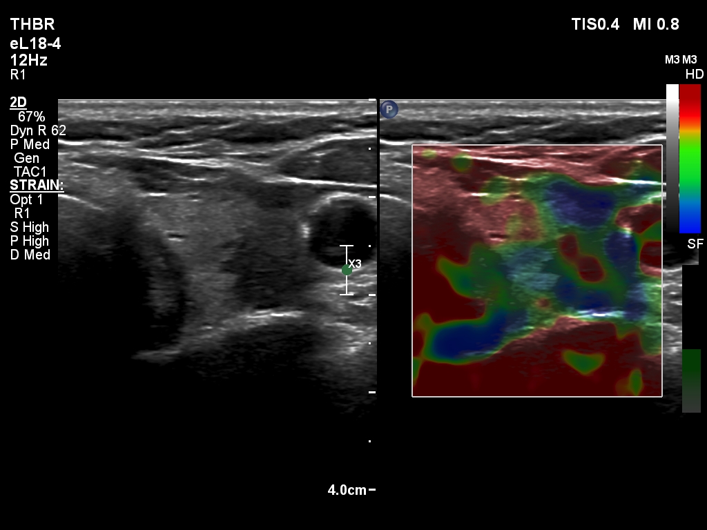 Right lobe, longitudinal scan