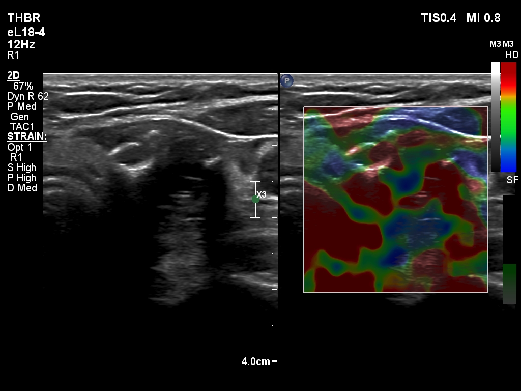 Right lobe, longitudinal scan
