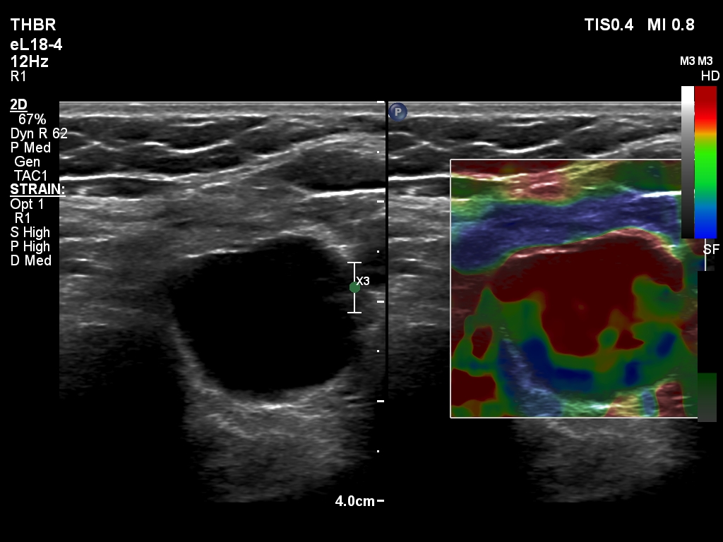 Right lobe, longitudinal scan