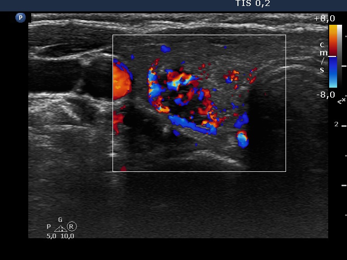 Right lobe, longitudinal scan