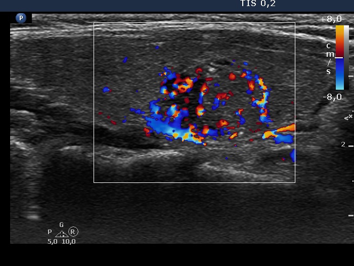 Right lobe, longitudinal scan