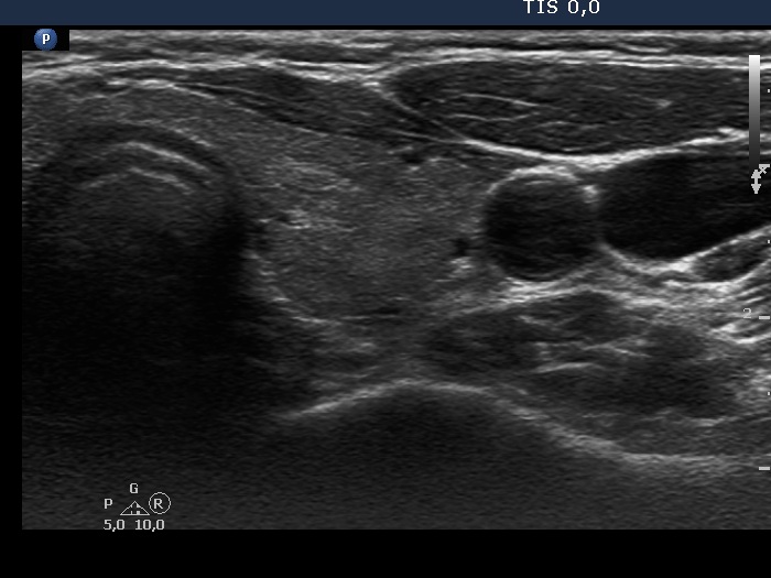 Right lobe, longitudinal scan